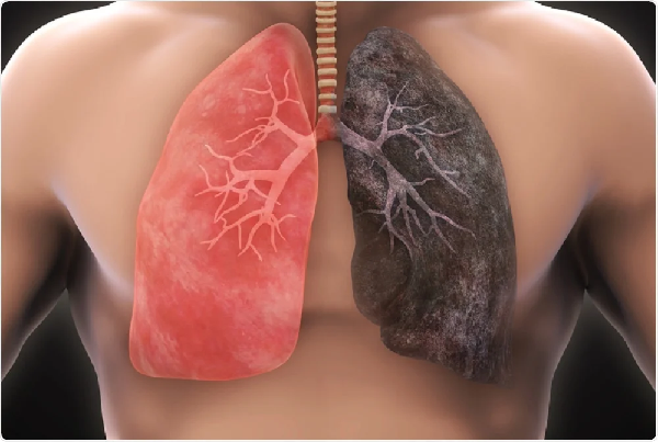 Endobronchial Ultrasound