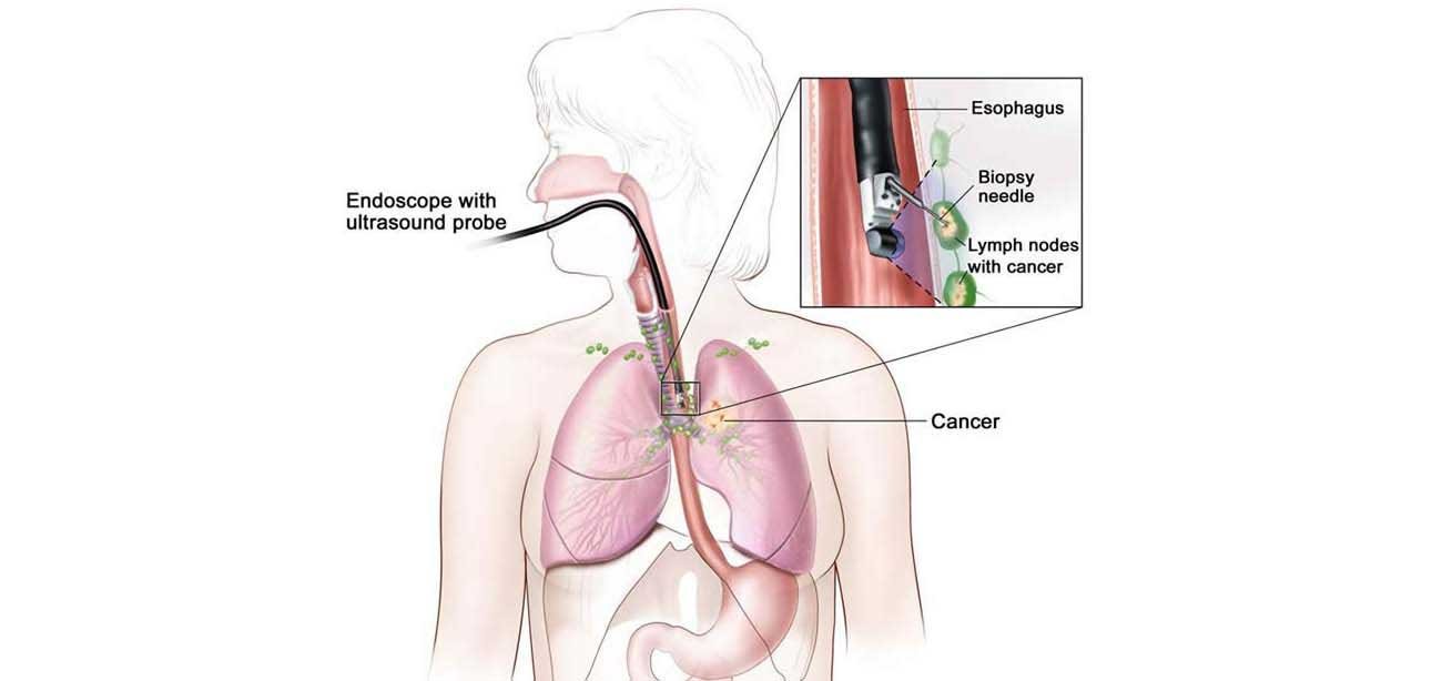 Endobronchial Ultrasound