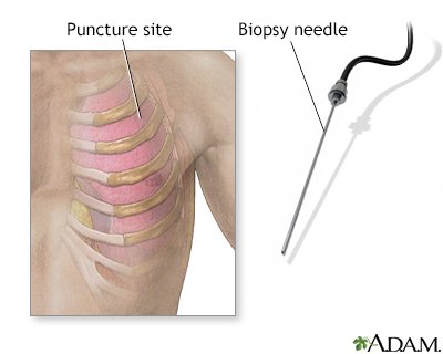 Understanding Pleural Biopsy A Crucial Diagnostic Procedure in Respiratory Medicine.