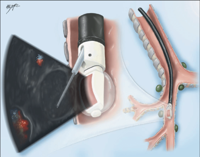 Exploring the Depths of Diagnosis Understanding Endobronchial Ultrasound