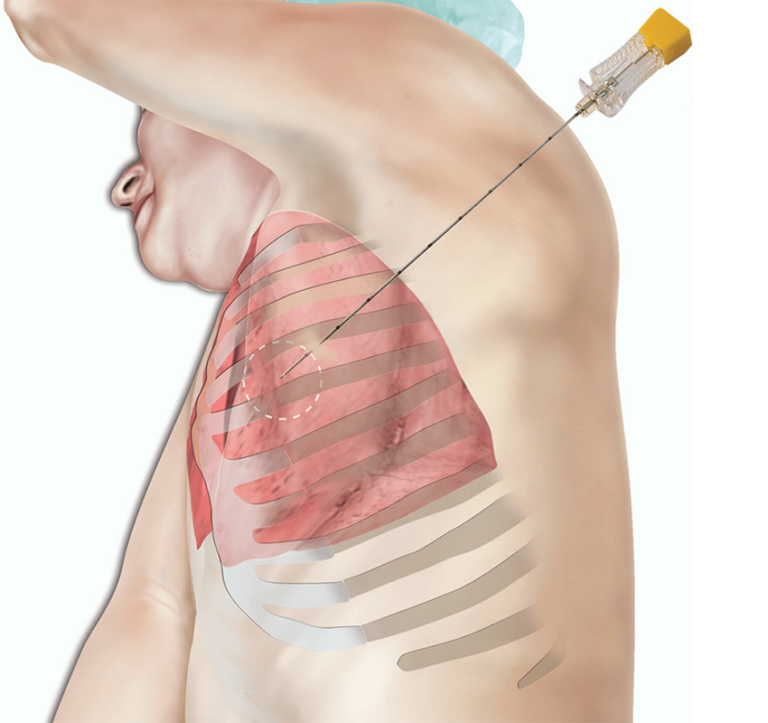 Pioneering Pleural Services Innovations in Respiratory Health.