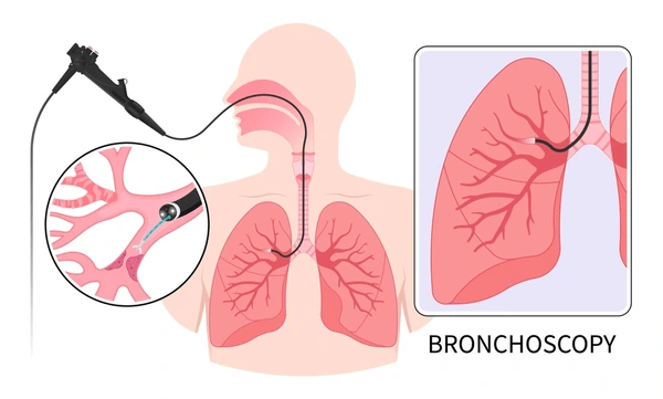 Respiratory Insights: Demystifying the Procedure of Bronchoscopy.