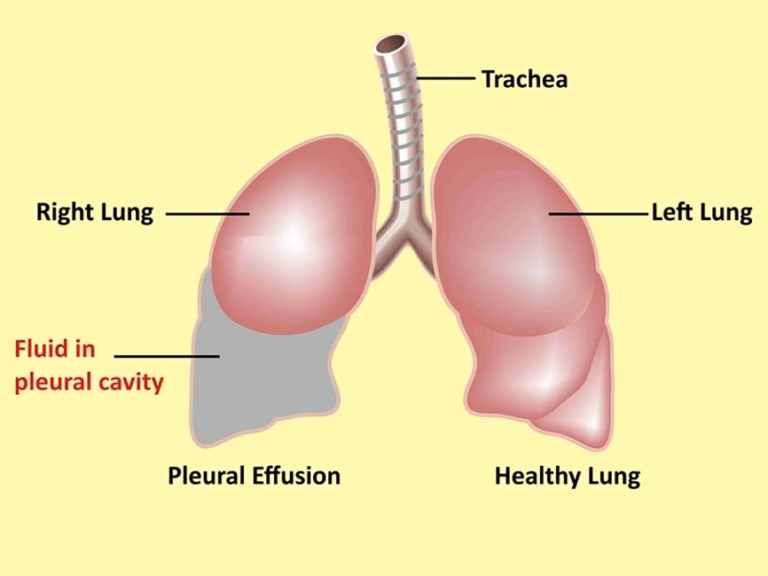 The Vital Role of Pleural Services in Respiratory Health.