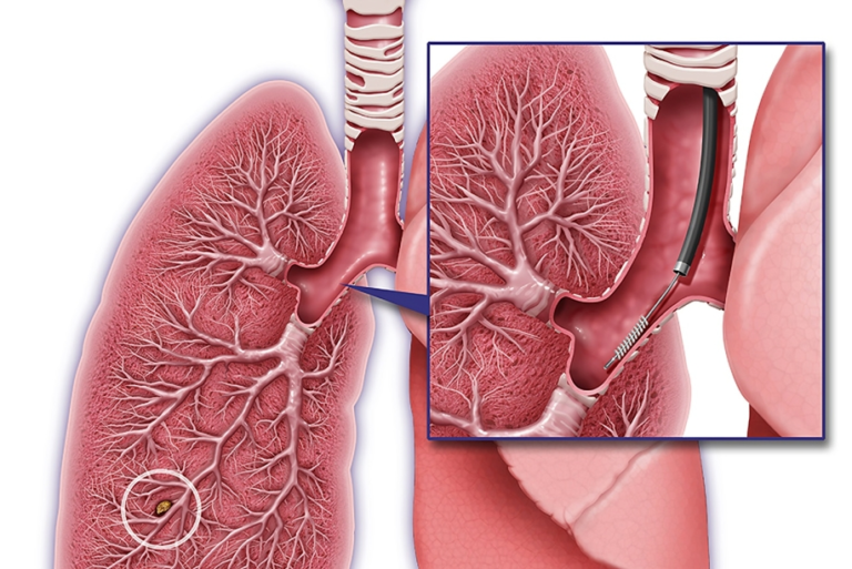 Navigating the Depths Understanding Lung Biopsy and Its Crucial Role in Diagnosis.