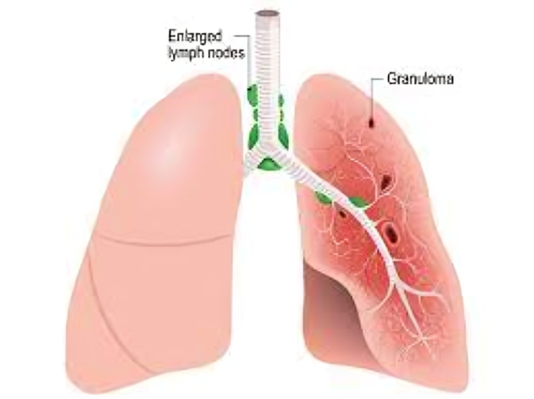 Navigating Sarcoidosis: Unraveling the Mysteries of a Multisystem Disorder.