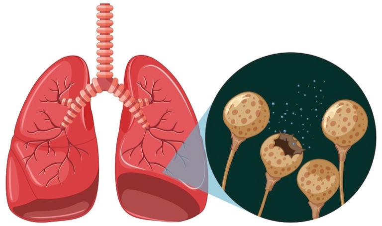 The Ultimate Guide to Understanding Lung Cancer Stages.