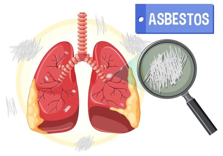 Comprehensive Treatment Plan for Lung Fibrosis in Naraina Vihar.