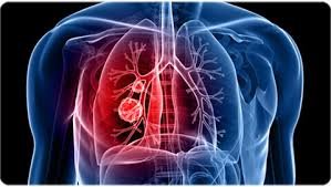 Best Specialist for Lung Cancer in Karol Bagh