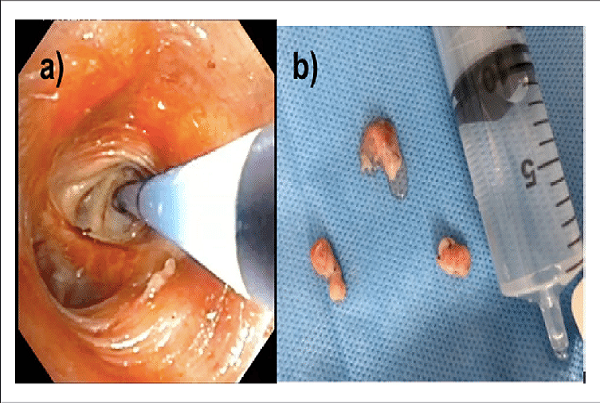 Best Bronchoscopic lung cryobiopsy in Dwarka