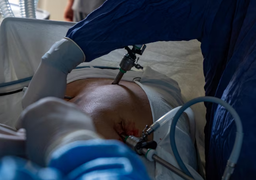 Best Therapeutic Thoracoscopy Treatment in Delhi