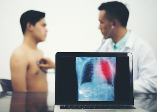 Best Pleurodesis Treatment in Central Delhi