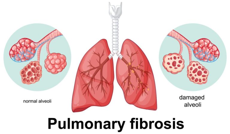 Best Doctor for Fibrosis of Lung Treatment in Delhi