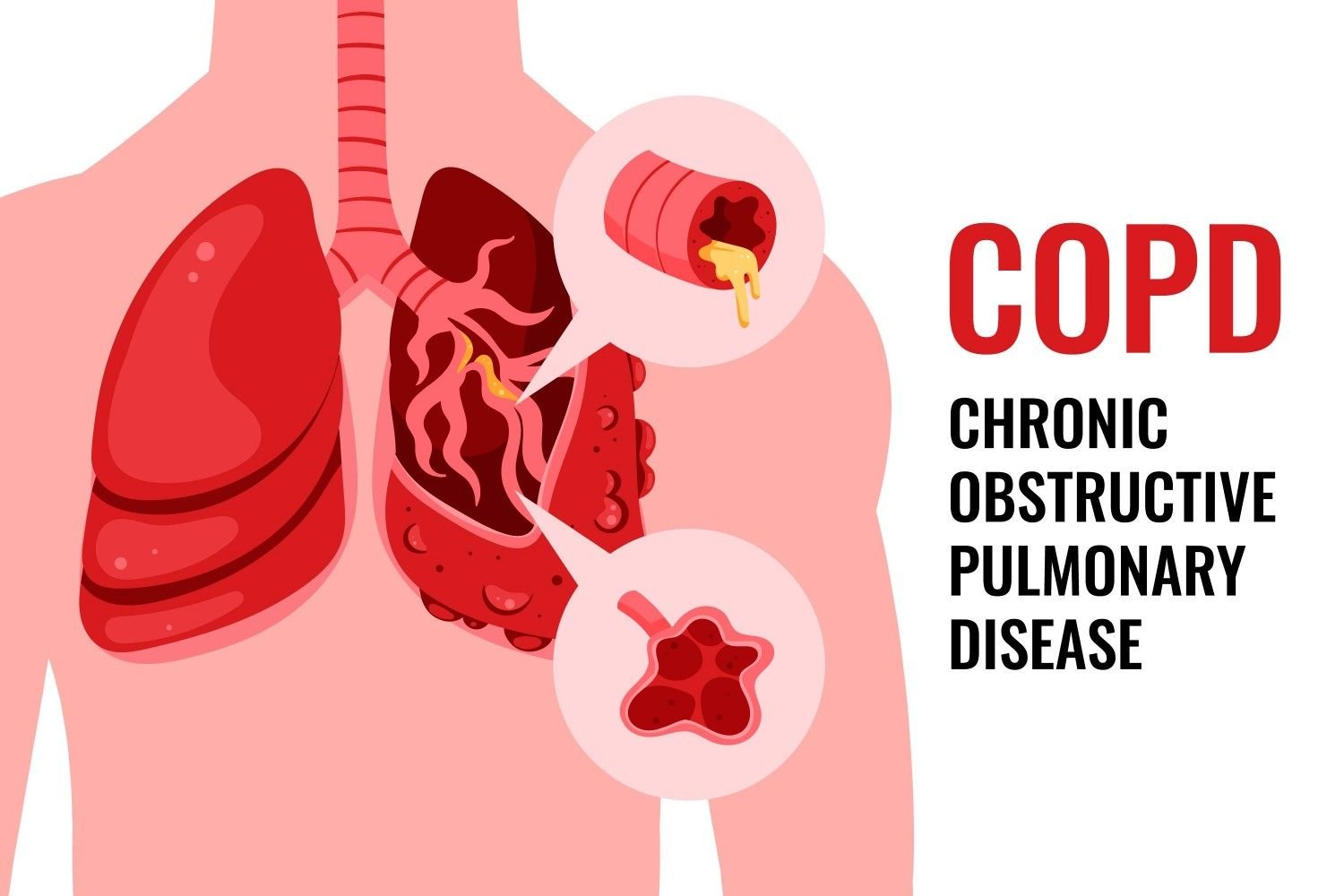COPD Treatment in Gurgaon