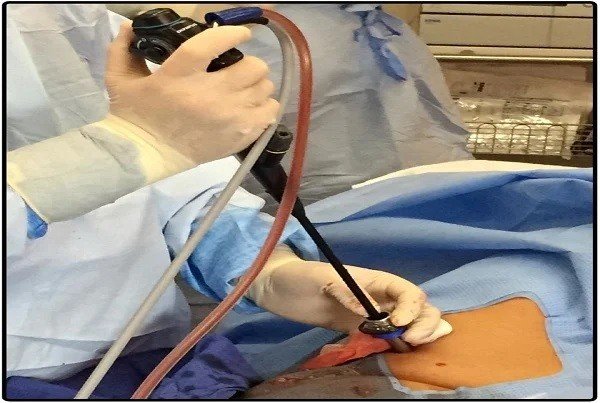 Therapeutic Thoracoscopy in Gurugram